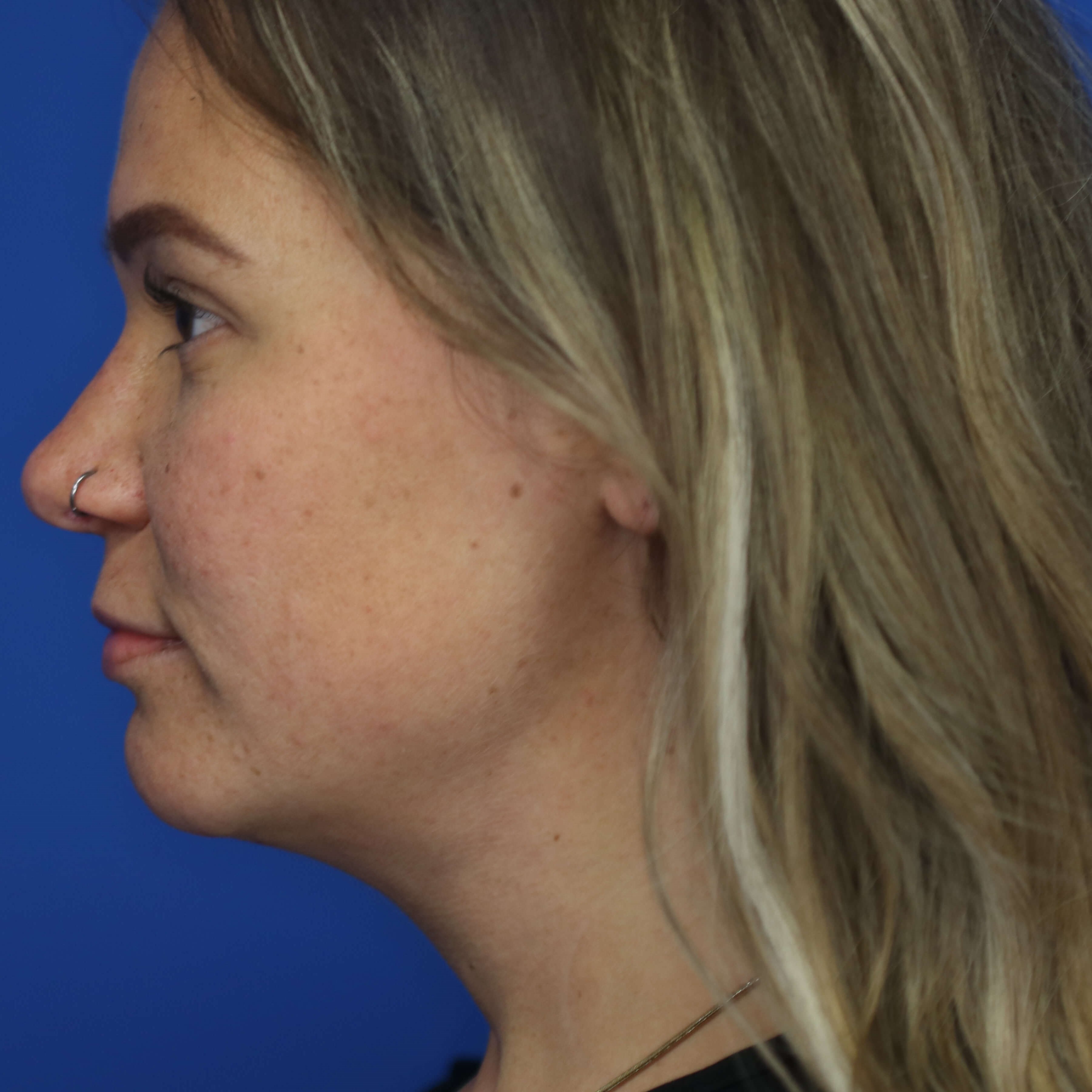 4 months post submentoplasty